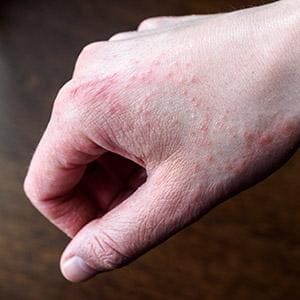 Eczema On Hands - Eczema Home Remedy